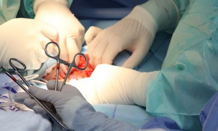 Ligamentotomía cirurxía para agrandar o pene